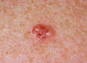 Warnings Signs Of Basal Cell Carcinoma