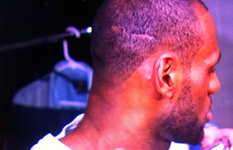 Lebron James Hair Transplant